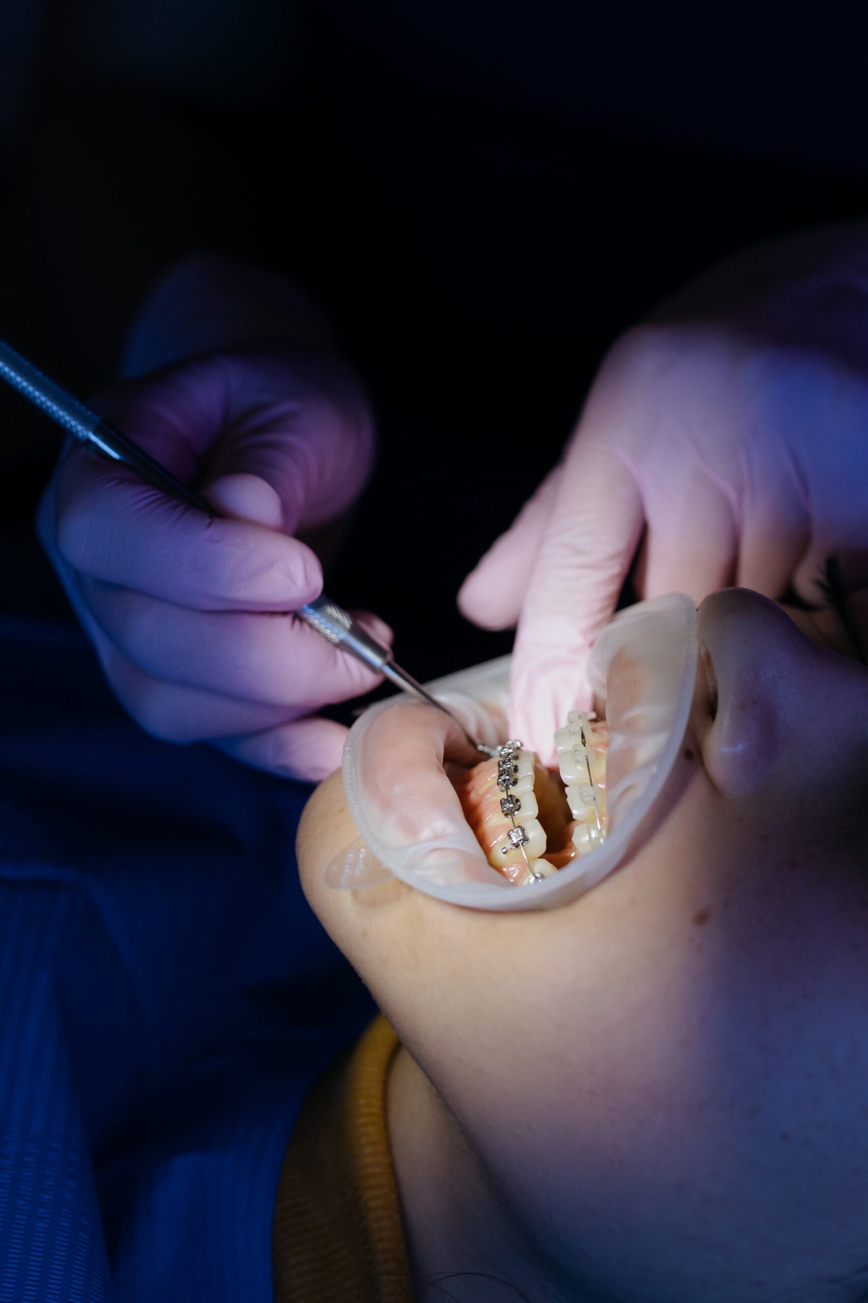 Aparaty ortodontyczne – leczenie wad zgryzu